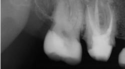 endodontic posts