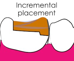 Figure 5: A composite placed in three increments will have three opportunities to form a meniscus at the free surface area in which post-gel point polymerization can occur without stress development. Figure 5: A composite placed in three increments will have three opportunities to form a meniscus at the free surface area in which post-gel point polymerization can occur without stress development.