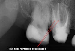 Figure 1: This first molar was nearly hopeless. However, placement of two fiber-reinforced posts cemented with resin cement and a core buildup salvaged the tooth and allowed crown placement. This is far better than removing the tooth and placing an implant.