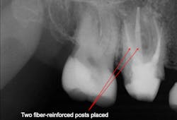 Figure 1: This first molar was nearly hopeless. However, placement of two fiber-reinforced posts cemented with resin cement and a core buildup salvaged the tooth and allowed crown placement. This is far better than removing the tooth and placing an implant. Figure 1: This first molar was nearly hopeless. However, placement of two fiber-reinforced posts cemented with resin cement and a core buildup salvaged the tooth and allowed crown placement. This is far better than removing the tooth and placing an implant.
