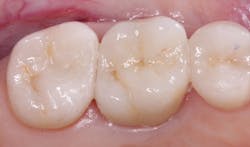 Figure 2: The first molar has been restored with IPS e.max. It should serve many years, since IPS e.max has a track record of not even 1% failure of single units in the 11 years it has been used internationally. Figure 2: The first molar has been restored with IPS e.max. It should serve many years, since IPS e.max has a track record of not even 1% failure of single units in the 11 years it has been used internationally.