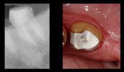 Figure 3: Typical post and core fiber-reinforced composite posts in two canals, posts placed to the depth of one-half of the bony supported tooth length, and a bonded composite buildup. Pins were not needed for this tooth because more than one-half of the coronal tooth structure was present.