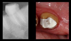 Figure 3: Typical post and core fiber-reinforced composite posts in two canals, posts placed to the depth of one-half of the bony supported tooth length, and a bonded composite buildup. Pins were not needed for this tooth because more than one-half of the coronal tooth structure was present. Figure 3: Typical post and core fiber-reinforced composite posts in two canals, posts placed to the depth of one-half of the bony supported tooth length, and a bonded composite buildup. Pins were not needed for this tooth because more than one-half of the coronal tooth structure was present.