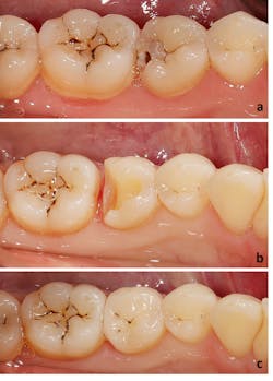 Case 1: A clinical case of e.max lithium disilicate glass ceramic partial coverage restoration. (A) caries present in a mandibular premolar. (B) Preparation for a partial coverage restoration. (C) e.max lithium disilicate glass ceramic partial coverage restoration adhesively bonded. Case 1: A clinical case of e.max lithium disilicate glass ceramic partial coverage restoration. (A) caries present in a mandibular premolar. (B) Preparation for a partial coverage restoration. (C) e.max lithium disilicate glass ceramic partial coverage restoration adhesively bonded.