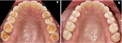Case 2: A clinical case of e.max lithium disilicate glass ceramic partial coverage restorations as a part of complex full-mouth reconstruction. (A) Preparation for partial coverage restorations on maxillary molars and premolars. (B) e.max lithium disilicate glass ceramic partial coverage restorations adhesively bonded.