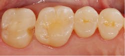 Case 3: A clinical case of e.max lithium disilicate glass ceramic partial coverage restoration bulk fracture. Case 3: A clinical case of e.max lithium disilicate glass ceramic partial coverage restoration bulk fracture.