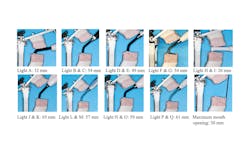 Figure 4: Mouth opening required for each LCU to correctly access the second last molar. Figure 4: Mouth opening required for each LCU to correctly access the second last molar.