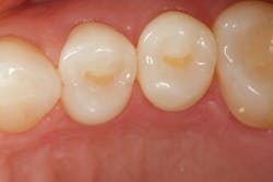 Figure 1: Cavity preparations, nos. 12 and 13 Figure 1: Cavity preparations, nos. 12 and 13