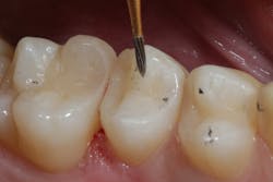 Figure 10: A small bullet carbide composite finishing bur is used to make minor adjustments. Note the anatomic detail of this “stackable” composite material. Figure 10: A small bullet carbide composite finishing bur is used to make minor adjustments. Note the anatomic detail of this “stackable” composite material.