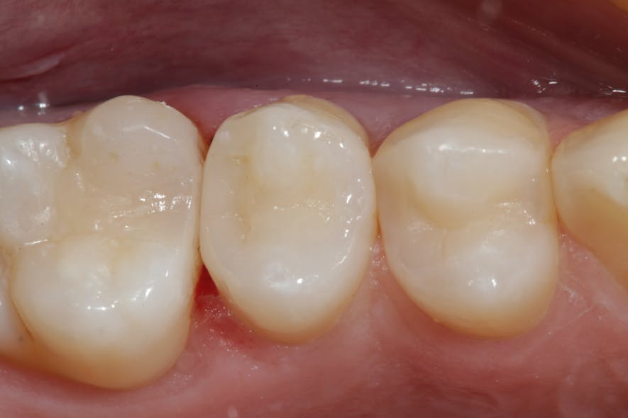Figure 11: Occlusal view of the completed restorations