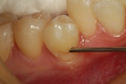 Figure 12: Class V preparation on tooth no. 28 being filled with composite Figure 12: Class V preparation on tooth no. 28 being filled with composite
