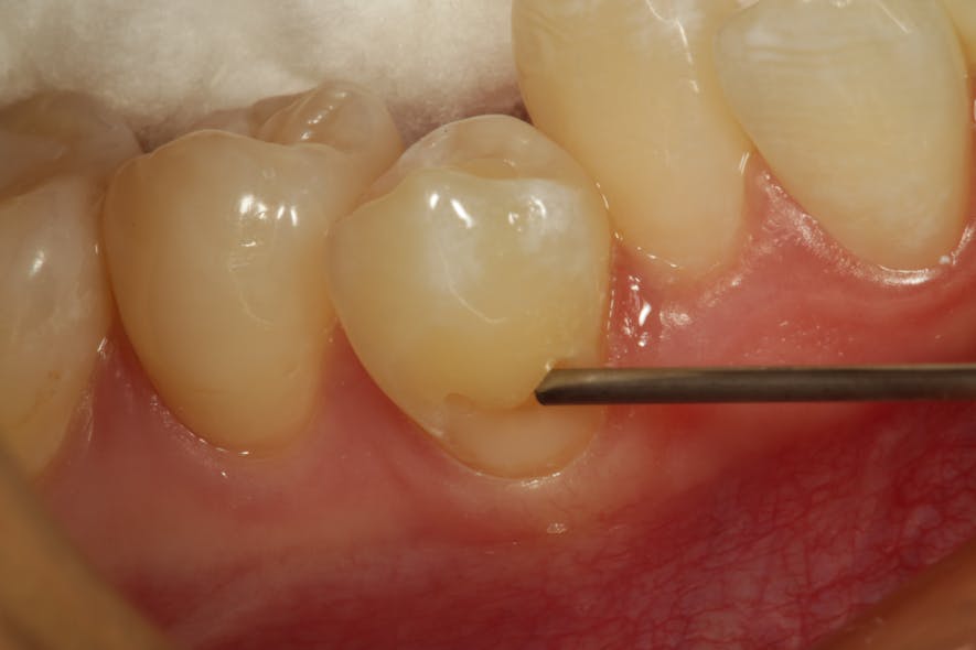 Figure 12: Class V preparation on tooth no. 28 being filled with composite