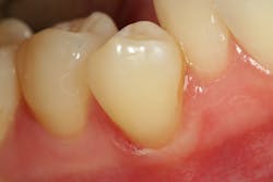 Figure 13: Facial view of completed restoration. Note the esthetic blend—an “invisible” restoration. Figure 13: Facial view of completed restoration. Note the esthetic blend—an “invisible” restoration.