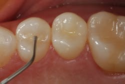 Figure 2: Composite dispensed into the cavity preparations Figure 2: Composite dispensed into the cavity preparations