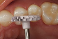 Figure 3: Composite polisher gets into the depths of the occlusal surface to create a smooth finish to the restorative material. Figure 3: Composite polisher gets into the depths of the occlusal surface to create a smooth finish to the restorative material.