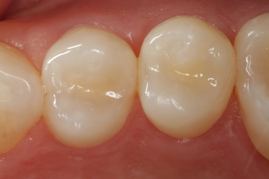 Figure 4: Occlusal view of completed restorations