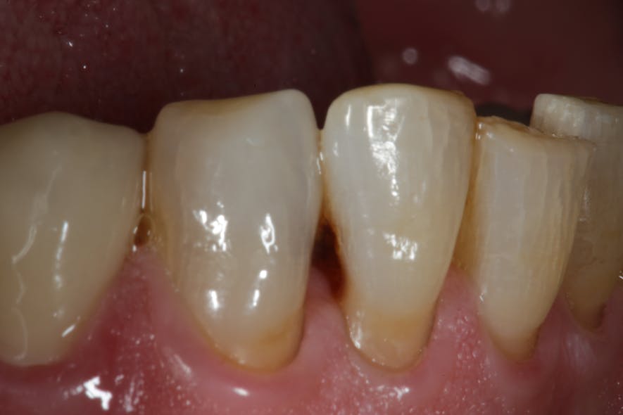 Figure 5: Class III caries lesion on the distal surface of tooth no. 26. Note that the lesion is primarily located apical to the cementoenamel junction on the root surface.