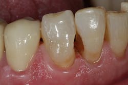 Figure 6: Preparations are made to remove decay. Figure 6: Preparations are made to remove decay.