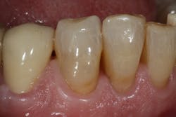 Figure 7: Complete restorations Figure 7: Complete restorations