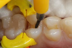 Figure 8: Application of bonding resin to no. 4 Figure 8: Application of bonding resin to no. 4