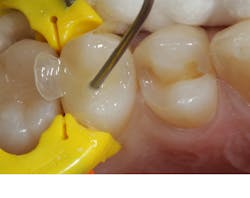 Figure 9: Activa Presto stacked in 2 mm increments Figure 9: Activa Presto stacked in 2 mm increments