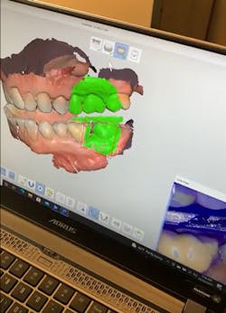 Figure 3: Bite registration capture Figure 3: Bite registration capture