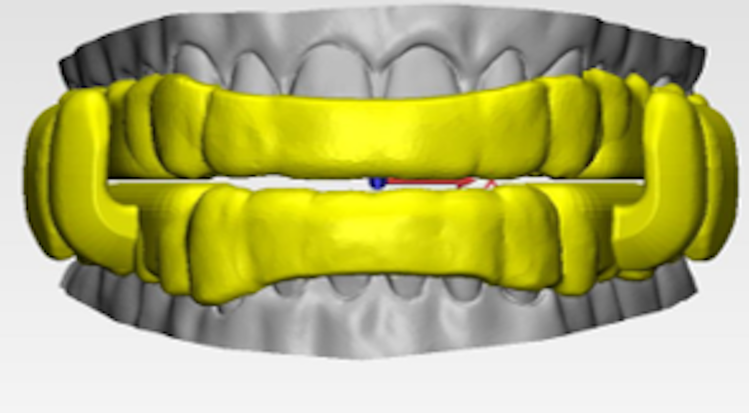 Figure 4: Digital rendering of the ProSomnus EVO Oral Therapy Appliance for obstructive sleep apnea.