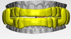 Figure 4: Digital rendering of the ProSomnus EVO Oral Therapy Appliance for obstructive sleep apnea.