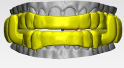 Figure 4: Digital rendering of the ProSomnus EVO Oral Therapy Appliance for obstructive sleep apnea. Figure 4: Digital rendering of the ProSomnus EVO Oral Therapy Appliance for obstructive sleep apnea.
