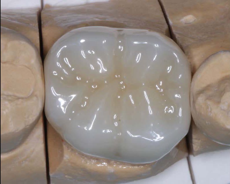 Figure 1: Class 5, tetragonal, 3Y zirconia—the original BruxZir has revolutionized the dental profession. It is now well proven to be the strongest and most durable ceramic restoration in dentistry, but color challenges still exist. Figure 1: Class 5, tetragonal, 3Y zirconia—the original BruxZir has revolutionized the dental profession. It is now well proven to be the strongest and most durable ceramic restoration in dentistry, but color challenges still exist.