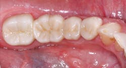 Figure 2: A three-unit fixed prosthesis and a separate single crown milled from class 5 zirconia with a thin layer of veneering ceramic/glaze to make it an acceptable color. However, the thin veneer/glaze will eventually wear off the occlusal surface. Figure 2: A three-unit fixed prosthesis and a separate single crown milled from class 5 zirconia with a thin layer of veneering ceramic/glaze to make it an acceptable color. However, the thin veneer/glaze will eventually wear off the occlusal surface.