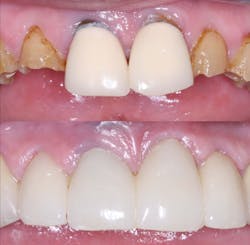 Figure 3: A four-unit fixed prosthesis milled from class 5 zirconia placed in a patient with extreme bruxing with pigment placed on the zirconia in the presintered stage to make the color acceptable. Figure 3: A four-unit fixed prosthesis milled from class 5 zirconia placed in a patient with extreme bruxing with pigment placed on the zirconia in the presintered stage to make the color acceptable.