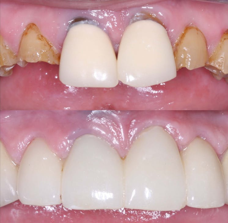 Figure 3: A four-unit fixed prosthesis milled from class 5 zirconia placed in a patient with extreme bruxing with pigment placed on the zirconia in the presintered stage to make the color acceptable.