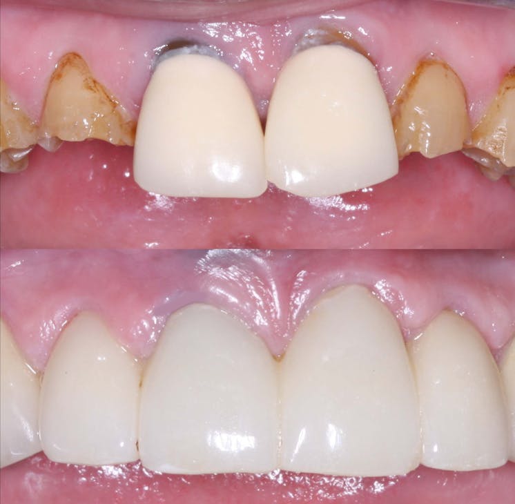 Figure 3: A four-unit fixed prosthesis milled from class 5 zirconia placed in a patient with extreme bruxing with pigment placed on the zirconia in the presintered stage to make the color acceptable. Figure 3: A four-unit fixed prosthesis milled from class 5 zirconia placed in a patient with extreme bruxing with pigment placed on the zirconia in the presintered stage to make the color acceptable.