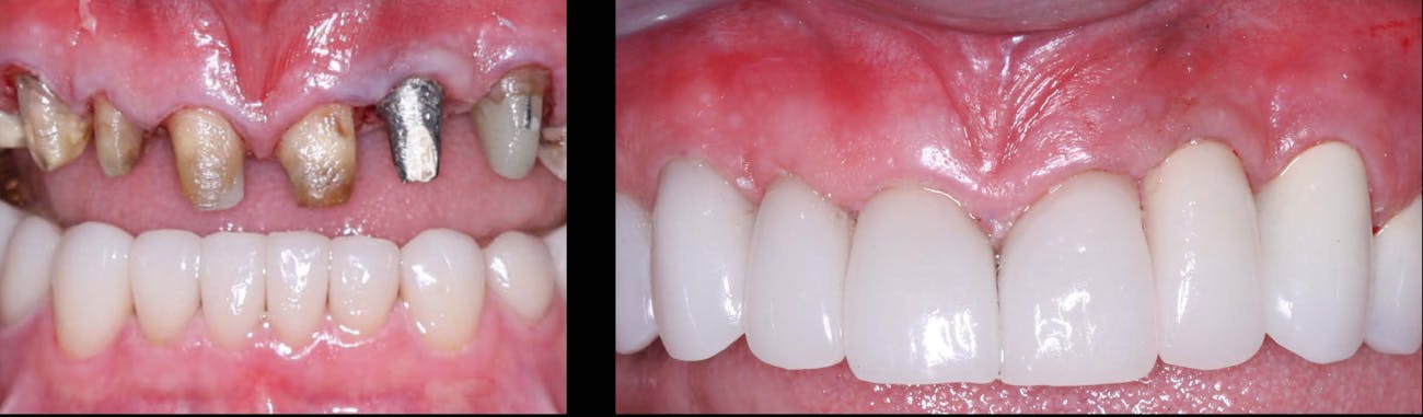 Figure 4: IPS e.max can cover even dark-colored teeth if it is at least 1.0 mm thick in all axial aspects. The left lateral incisor replacement is an implant. It has a thin metal opaqued coping placed over the implant, making the color of the class 3 ceramic restoration (lithium disilicate) acceptable. Figure 4: IPS e.max can cover even dark-colored teeth if it is at least 1.0 mm thick in all axial aspects. The left lateral incisor replacement is an implant. It has a thin metal opaqued coping placed over the implant, making the color of the class 3 ceramic restoration (lithium disilicate) acceptable.
