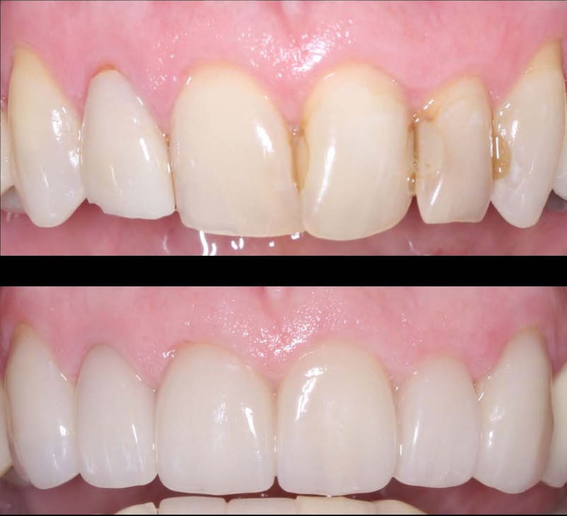 Figure 5: The strength and esthetics of IPS e.max for single crowns is unexcelled by other materials. Figure 5: The strength and esthetics of IPS e.max for single crowns is unexcelled by other materials.