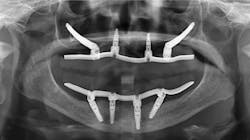 Figure 4: This patient treated elsewhere with the “all-on-4” concept had overclosed vertical dimension and many prematurities on the zirconia occlusion. Her face was shrunken. There were denture sore spots and pain of unknown origin. We removed the fixed prostheses, made bars, and fabricated removable overdentures with resin teeth. After some months of adjusting, the patient can now eat and speak well. Most edentulous patients are best served with removable prostheses, not fixed ones. Figure 4: This patient treated elsewhere with the “all-on-4” concept had overclosed vertical dimension and many prematurities on the zirconia occlusion. Her face was shrunken. There were denture sore spots and pain of unknown origin. We removed the fixed prostheses, made bars, and fabricated removable overdentures with resin teeth. After some months of adjusting, the patient can now eat and speak well. Most edentulous patients are best served with removable prostheses, not fixed ones.