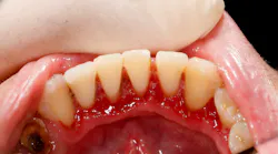 Gum Disease