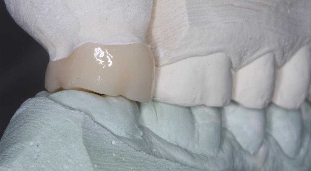 Figure 2: Note the low occlusal spacing the technician designed and milled for the zirconia crown. This was between 0.5 mm and 1.0 mm. The opposing tooth will require several weeks or months to provide extrusion, with the strong possibility of breaking the overloaded adjacent tooth and significantly changing the occlusion.