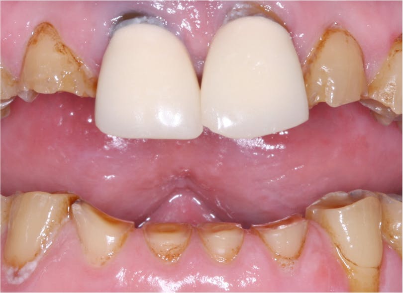 Figure 3: This patient, a grinding bruxer, had porcelain-fused-to-metal crowns placed by a dentist many years ago. Note the excessive wear on the lower anterior teeth. Some of the restorations described in this article are showing wear of the opposing dentition in CR/TRAC in vivo research but not as severely as shown here with older feldspathic ceramic.