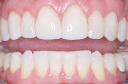 Figures 2 and 3: Ceramic veneers are a well-proven and beautiful restoration for teeth with adequate lingual surfaces. They almost died during the recession followed by COVID-19. But they are coming back! This technique is an example of a concept that requires some education and time for incorporation into practice but produces an excellent result and high patient satisfaction. Figures 2 and 3: Ceramic veneers are a well-proven and beautiful restoration for teeth with adequate lingual surfaces. They almost died during the recession followed by COVID-19. But they are coming back! This technique is an example of a concept that requires some education and time for incorporation into practice but produces an excellent result and high patient satisfaction.