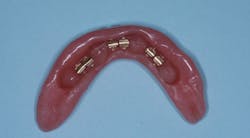 Figure 5: Retention for the removable prostheses described in figure 4 was obtained by metal clips that fit over the bars. Figure 5: Retention for the removable prostheses described in figure 4 was obtained by metal clips that fit over the bars.