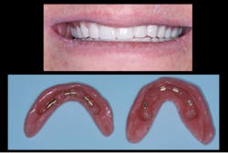 Figure 6: A grateful patient now has her face properly filled out again, with ease of cleaning, easy repair if necessary, and comfortable properly adjusted occlusion with resin teeth that wear by themselves into comfortable occlusion over time.