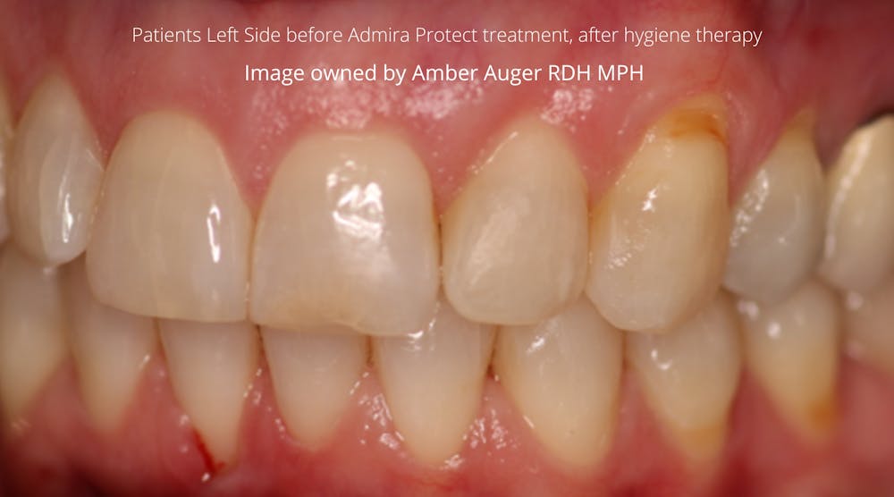 Figure 1: Patient&rsquo;s left side before Admira Protect treatment and after hygiene therapy.