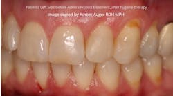 Figure 1: Patient&rsquo;s left side before Admira Protect treatment and after hygiene therapy.