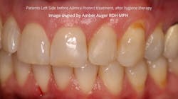 Figure 1: Patient’s left side before Admira Protect treatment and after hygiene therapy. Figure 1: Patient’s left side before Admira Protect treatment and after hygiene therapy.