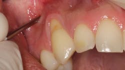 Figure 1: Pinhole microincision being placed into the vestibule Figure 1: Pinhole microincision being placed into the vestibule