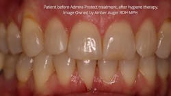 Figure 2: Patient before Admira Protect treatment, after hygiene therapy. Figure 2: Patient before Admira Protect treatment, after hygiene therapy.