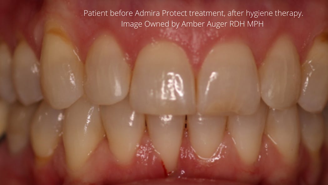 Figure 2: Patient before Admira Protect treatment, after hygiene therapy.