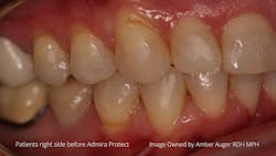 Figure 3: Patient’s right side before Admira Protect. Figure 3: Patient’s right side before Admira Protect.